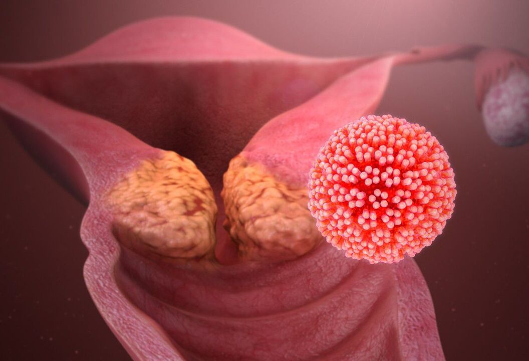 Lesione da HPV della cervice