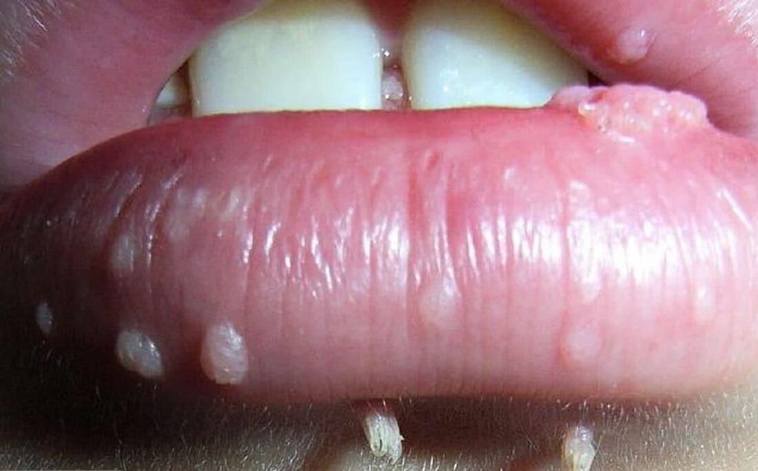 papilloma virus sulle labbra della bocca