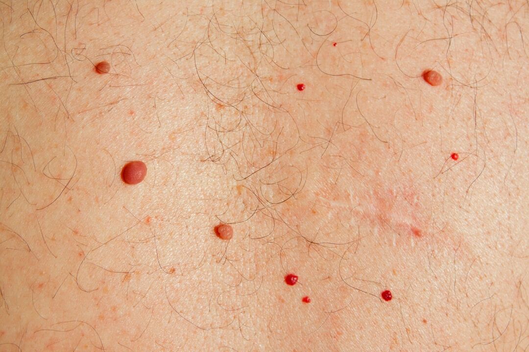 Papillomi sul corpo causati dall'HPV
