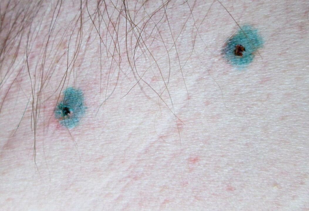 Segni sulla pelle dopo la rimozione laser dei papillomi