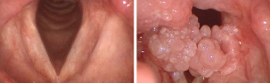 Papilloma virus in bocca
